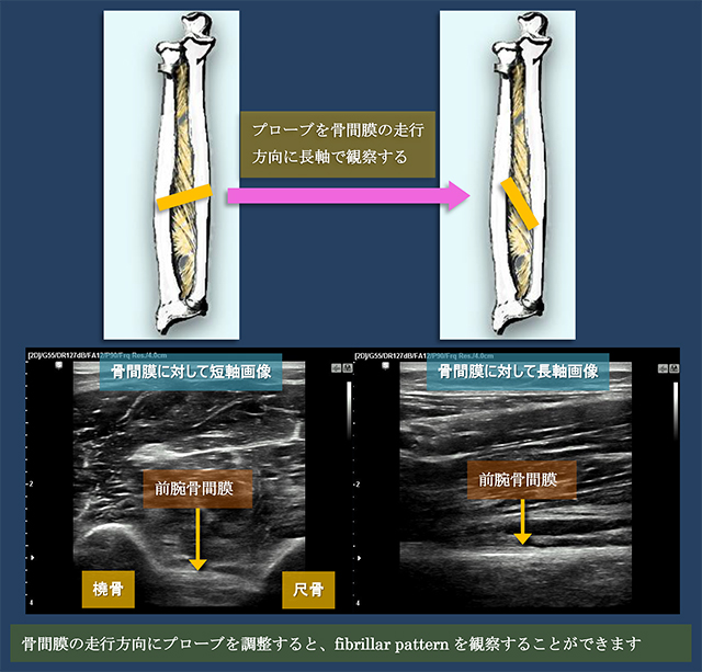 図　前腕骨間膜の短軸・長軸走査