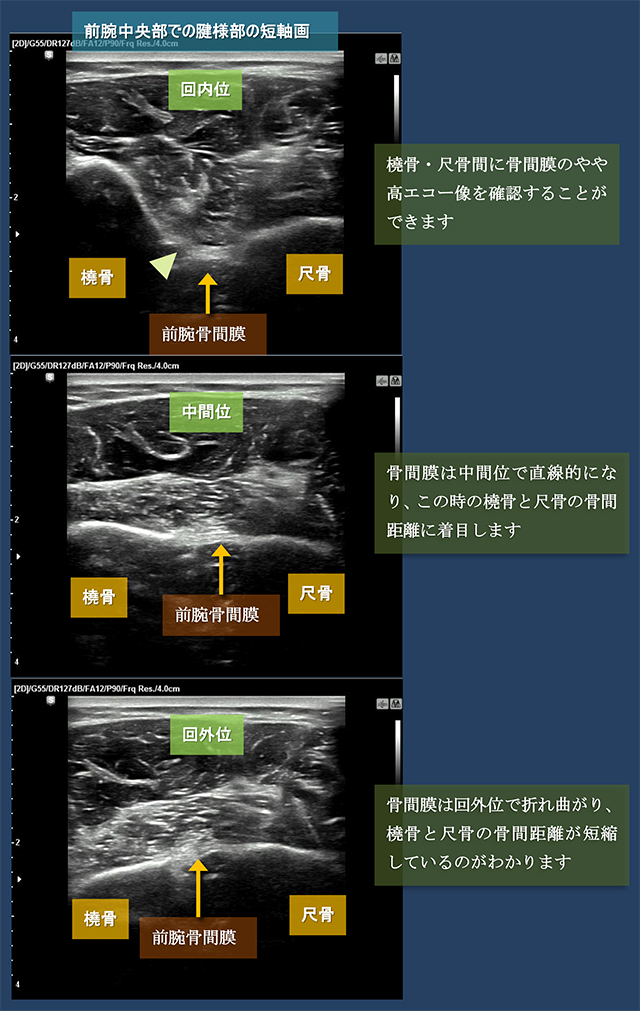 図　前腕骨間膜　腱様部での回内・回外での振る舞い