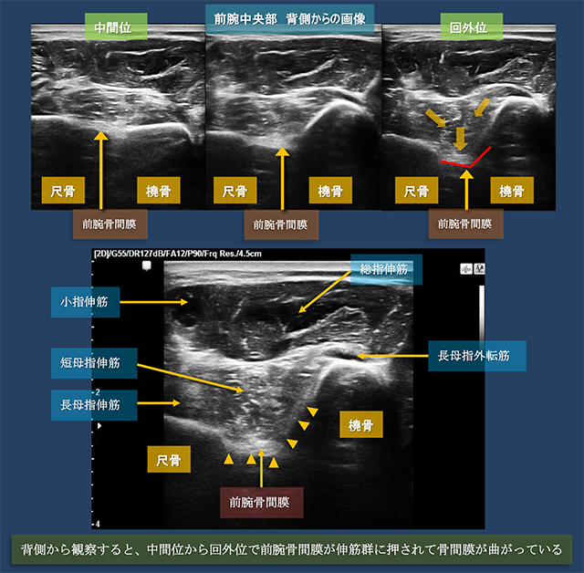 図　前腕骨間膜　腱様部での回内・回外での振る舞い　背側からの観察