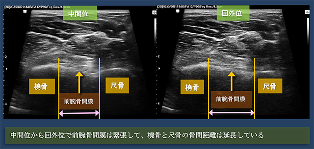 図　前腕骨間膜　膜様部での回内・回外での振る舞い