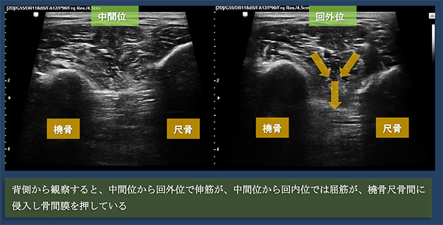 図　前腕骨間膜の膜様部での背側からの観察