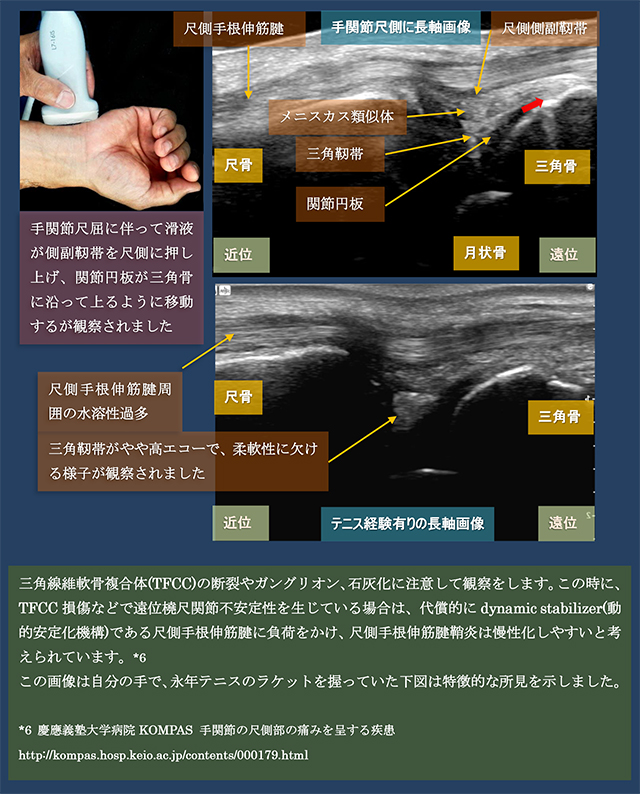 図　三角線維軟骨複合体(TFCC)の長軸走査