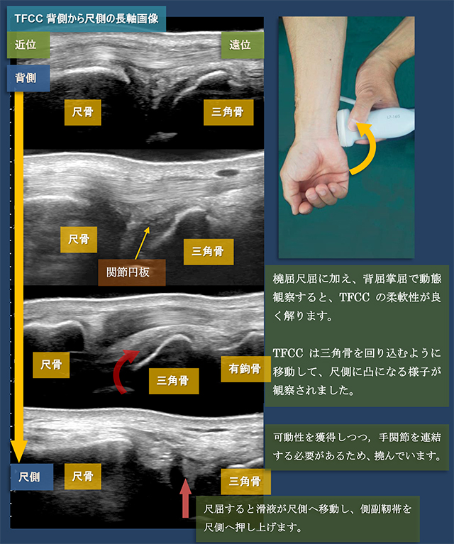 図　三角線維軟骨複合体(TFCC)背側から尺側の長軸画像