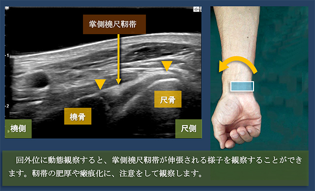 図　掌側橈尺靭帯の観察法