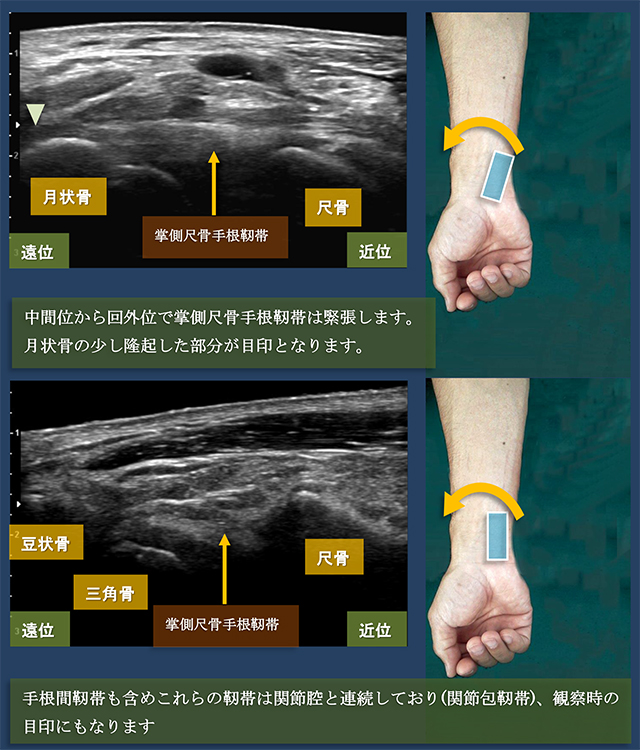 図　掌側尺骨手根靭帯の観察法