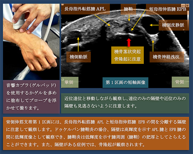 図　背側伸筋支帯第1区画の短軸走査