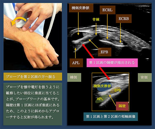 図　背側伸筋支帯第1区画の隔壁をしっかり確認したい