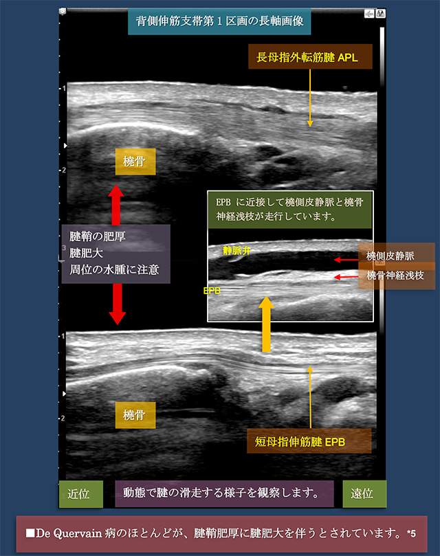 図　背側伸筋支帯第1区画の長軸走査