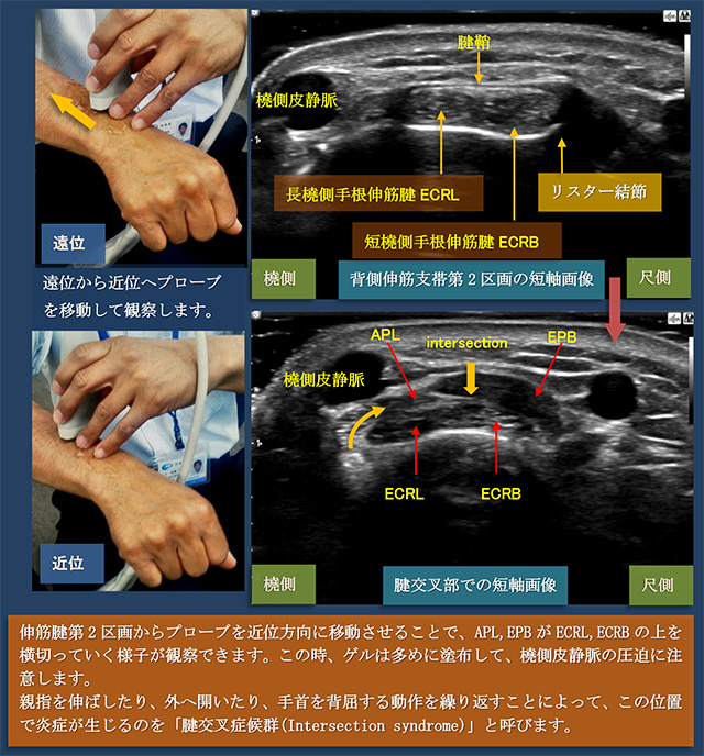 図　背側伸筋支帯第2区画と腱交叉部の短軸画像