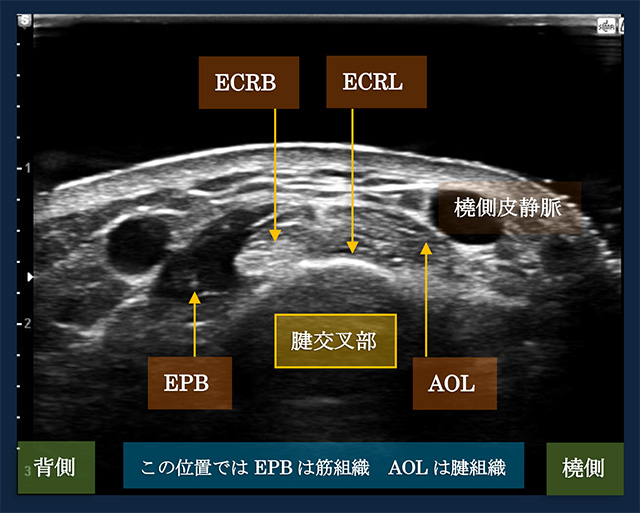 図　腱交叉部の超音波観察法