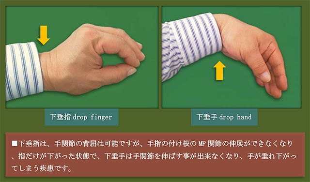 図　下垂指と下垂手