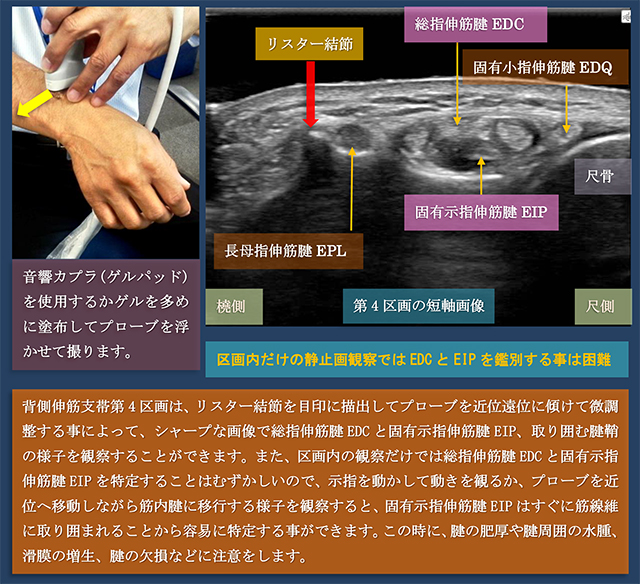 図　第4区画　総指伸筋腱と固有示指伸筋腱の超音波観察法　短軸走査