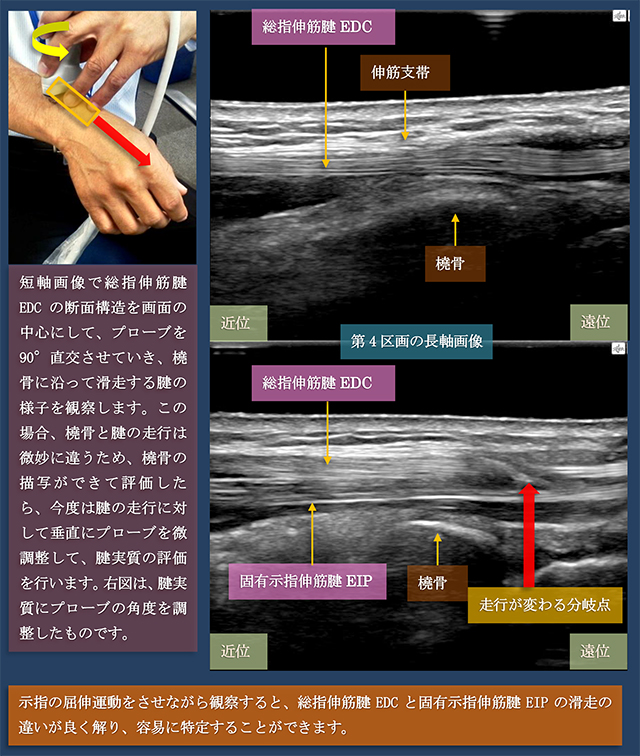 図　第4区画　総指伸筋腱と固有示指伸筋腱の超音波観察法　長軸走査