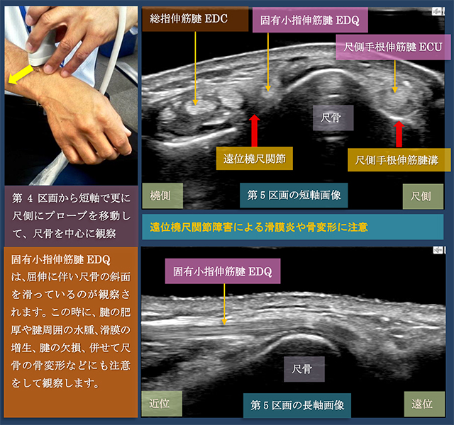 図　第5区画　固有小指伸筋腱の超音波観察法　短軸と長軸走査