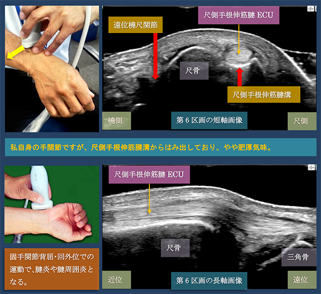 図　第6区画　尺側手根伸筋腱の超音波観察法　短軸と長軸走査