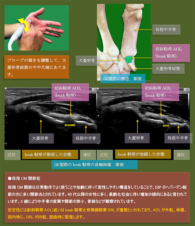 図　母指CM関節　掌側からの超音波観察法