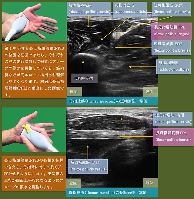 図　小指球筋(hypothenar muscles)と小指外転筋(abductor digiti minimi)の超音波観察法