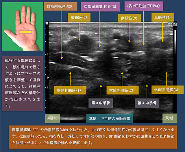 図　掌側からの中手筋の短軸での超音波観察法