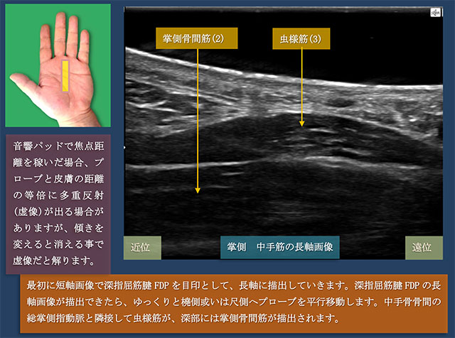 図　掌側からの中手筋の長軸での超音波観察法