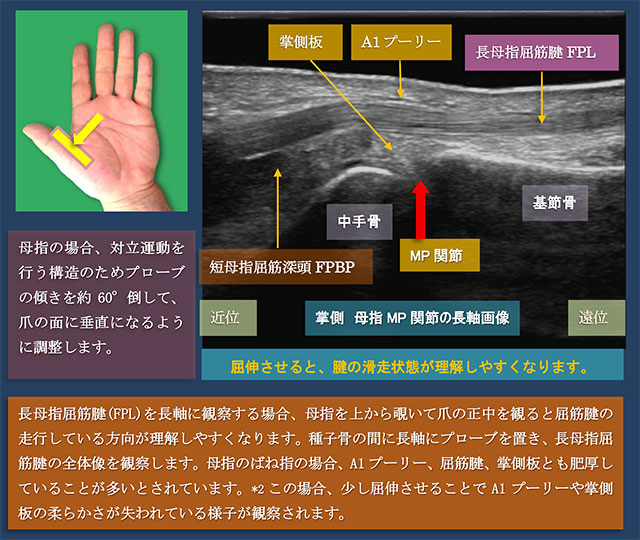 図　母指MP関節の長軸走査　掌側から