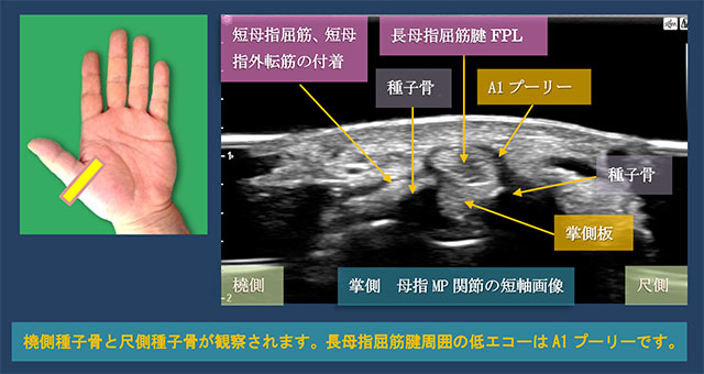 図　母指MP関節の短軸走査　掌側から