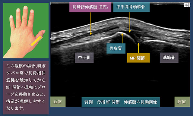 図　母指MP関節の長軸走査　背側から