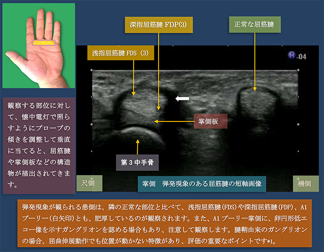 図　掌側　弾発現象のある屈筋腱の短軸での超音波観察