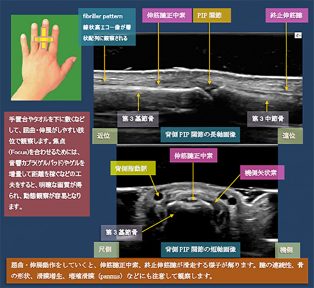 図　背側からのPIP関節の超音波観察法(長軸・短軸)