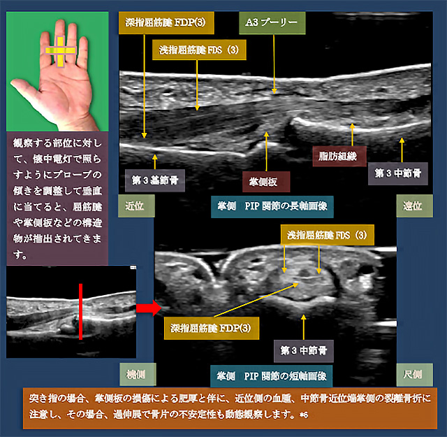 図　掌側からのPIP関節の超音波観察法(長軸・短軸)