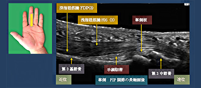 図　手綱靭帯の超音波観察法