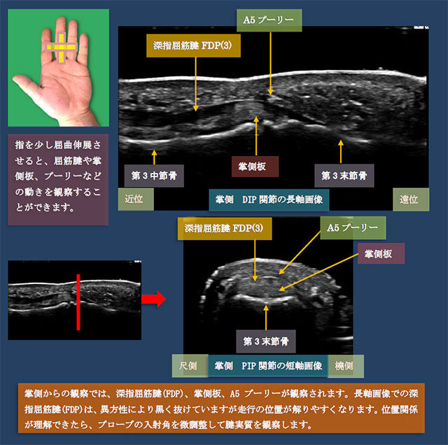 図　掌側からのPIP関節の超音波観察法(長軸・短軸)