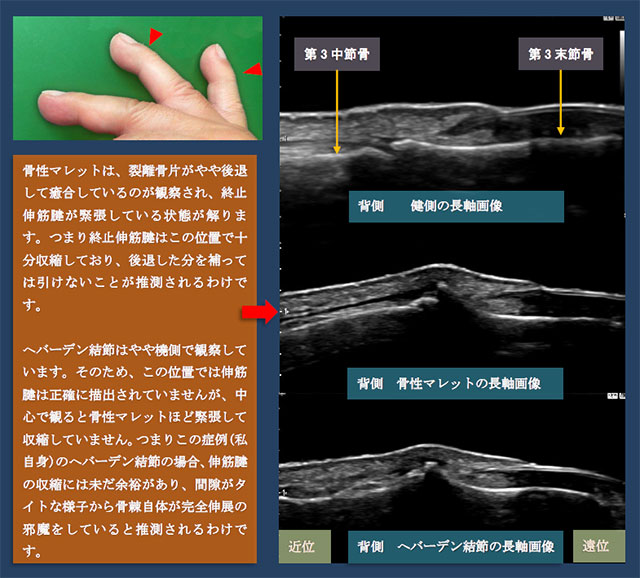 図　骨性マレットとへバーデン結節の超音波による比較観察(背側)