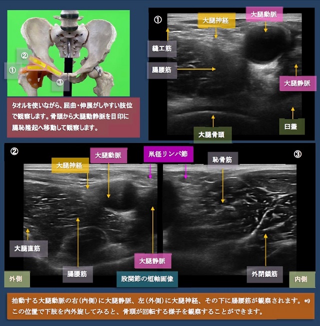 図　股関節前面の超音波観察法(短軸)　骨頭から腸恥隆起