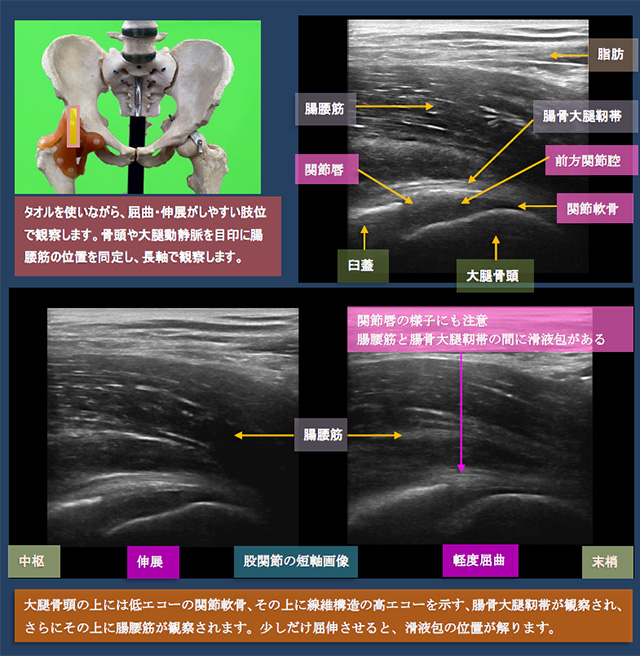 図　股関節前面の超音波観察法(長軸)　腸腰筋と関節唇