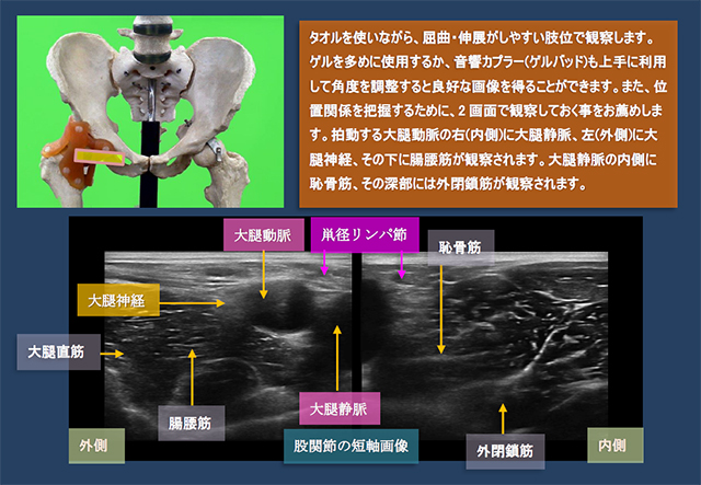 図　股関節前方の超音波観察法　短軸画像によるスカルパ三角の全体像