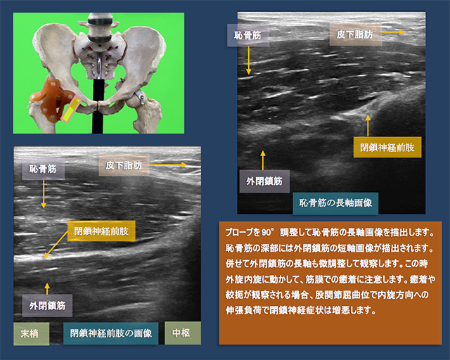 図　股関節前方の観察法　恥骨筋と外閉鎖筋、閉鎖神経について