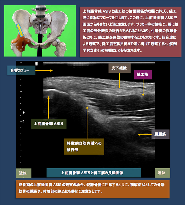 図　股関節前方の超音波観察法
上前腸骨棘AIISと縫工筋の長軸画像