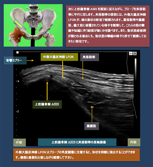 図　股関節前方の超音波観察法
鼡径靭帯(IL : inguinal ligament)の長軸画像と外側大腿皮神経LFCN