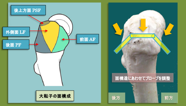 図　大転子のファセット(facet 面)とプローブワーク