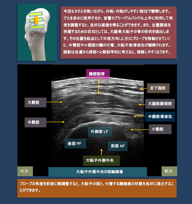 図　股関節外側の超音波観察法
短軸画像による大転子と中殿筋、小殿筋、腸脛靭帯