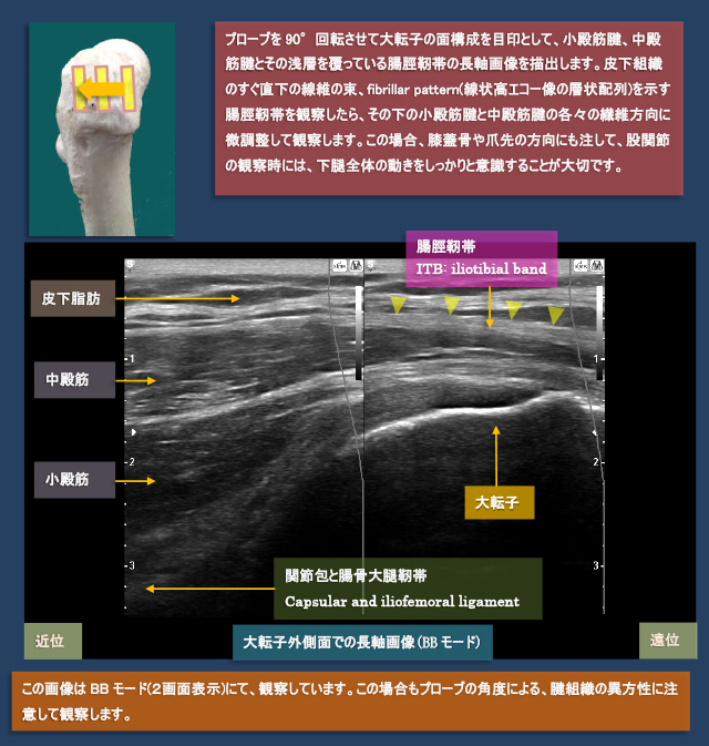 図　股関節外側の超音波観察法
長軸画像による大転子と中殿筋、小殿筋、腸脛靭帯