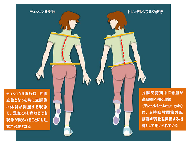 図　トレンデレンブルグ歩行とデュシェンヌ歩行