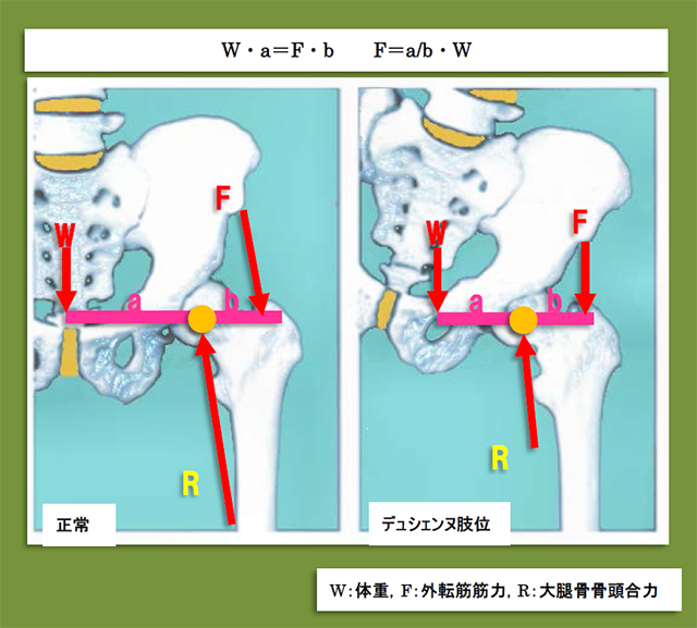 図　片脚立位時の骨頭合力*11