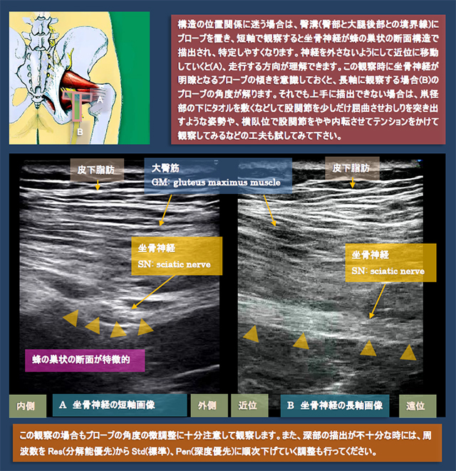 図　股関節後方の超音波観察法　坐骨神経