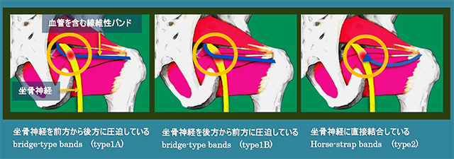 図　坐骨神経を絞扼する血管を含む線維性バンドの形態的な特徴による分類 *18参考