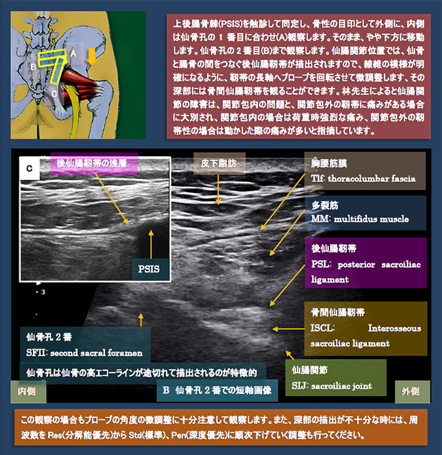 図　後方からの仙腸関節の超音波観察法　仙腸観察と後仙腸靭帯